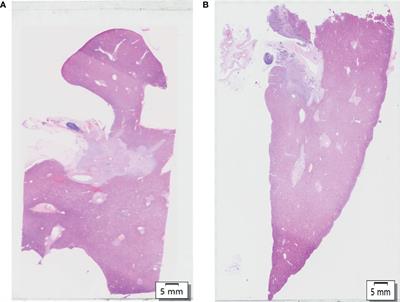 Characteristic of Perineural Invasion in Hilar Cholangiocarcinoma Based on Whole-Mount Histologic Large Sections of Liver